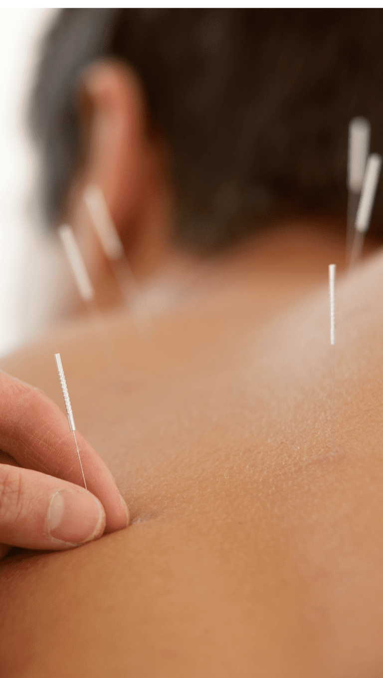 Akupunkturbehandlung: Dünne Nadeln werden sanft in die Haut einer Person gestochen, um Schmerzen zu lindern und das Wohlbefinden zu fördern.